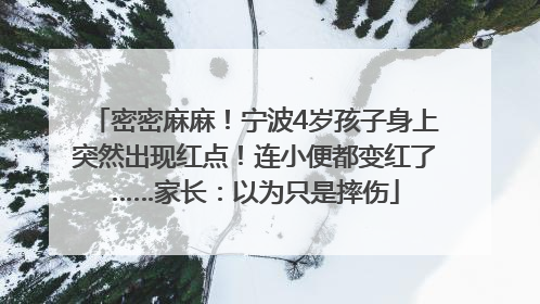 密密麻麻！宁波4岁孩子身上突然出现红点！连小便都变红了……家长：以为只是摔伤